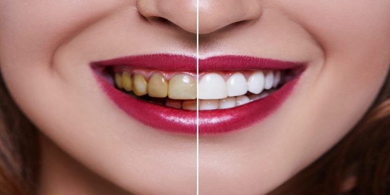 Oral Care – FAQs about Whitening Strips